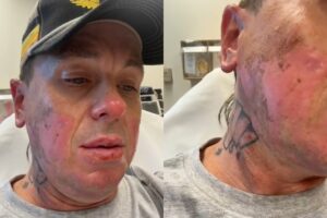 Sid Wilson, do Slipknot, queimou o rosto