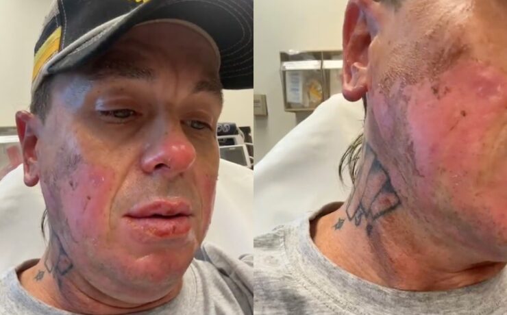 Sid Wilson, do Slipknot, queimou o rosto