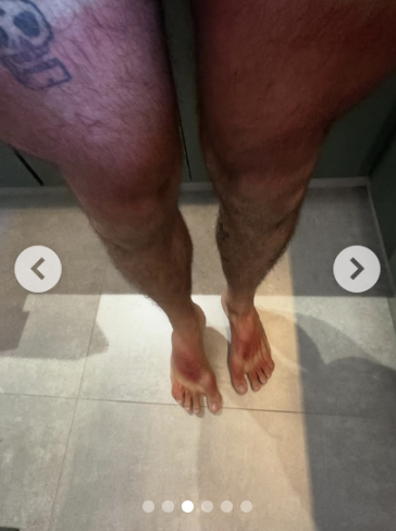 'Bronzeado ruim' vira atração no bloco da Lagum em Belo Horizonte 3 Pedro Calais, vocalista da banda Lagum exibe "bronzeado que deu ruim" (reprodução Instagram)