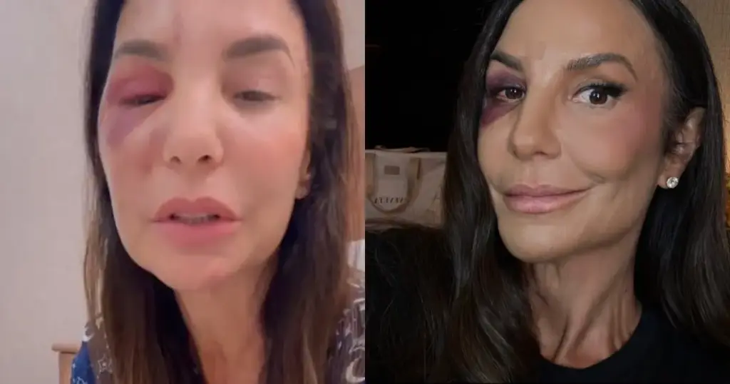 Ivete Sangalo atualiza estado de saúde após cirurgia 1 Ivete Sangalo