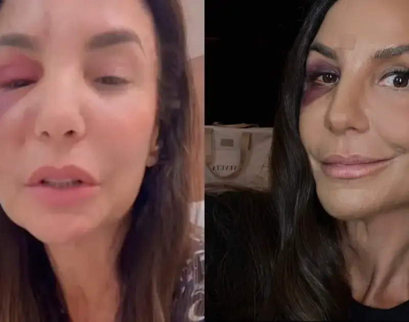 Ivete Sangalo atualiza estado de saúde após cirurgia